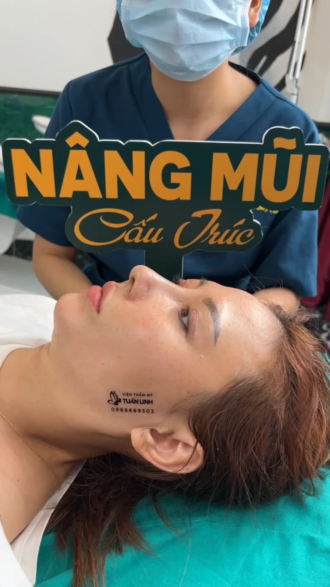 Tái khám sau 1 tháng nâng mũi cấu trúc sụn #Surgiform - Dáng mũi đã gom lại rất tự nhiên