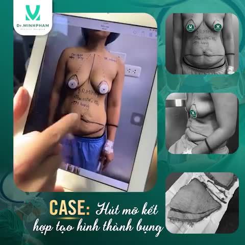 Case hút mỡ tạo hình thành bụng chuyển rốn sau 90ph thực hiện.