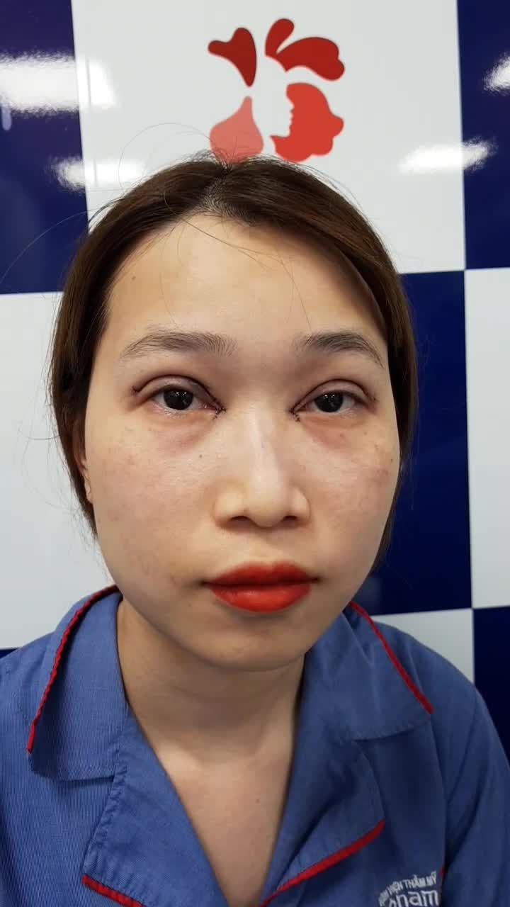Combo Cắt mí + Tạo khóe Tạo mắt 2 mí to tròn