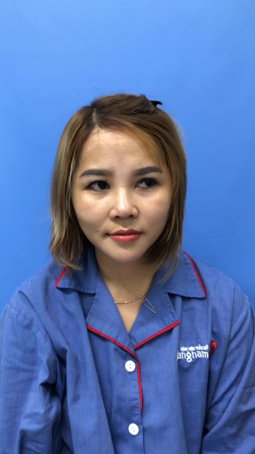 Kết quả Nâng mũi + Độn Cằm xinh đẹp của nữ khách hàng tại Kangnam Hà Nội
