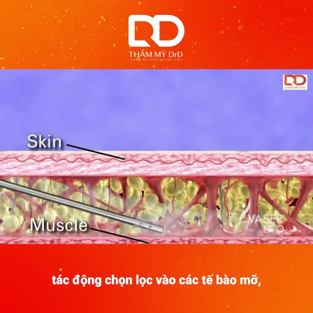 Công nghệ VASERlipo diệu kỳ khi đánh tan mỡ  tối đa nhưng vẫn bảo tồn tối đa tổ chức mạch máu, thần kinh và mô liên kết.