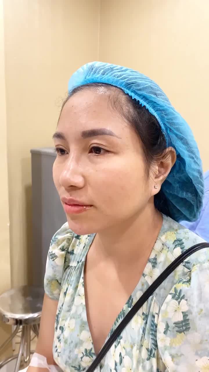 Kết quả quá trình tiêm filler tại bệnh viện thẫm mỹ Đông Á