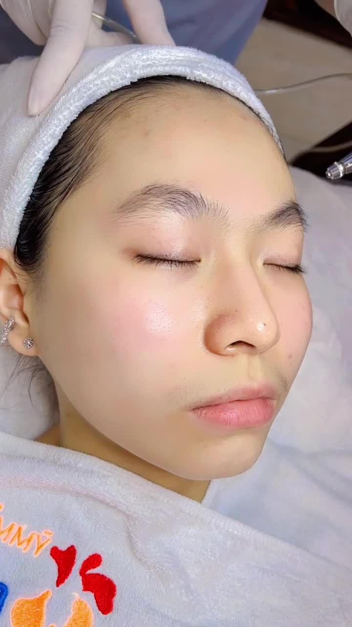 Điều trị mụn cực hiệu quả với công nghệ điều trị mụn De-acne của Kangnam chỉ với 6 buổi điều trị