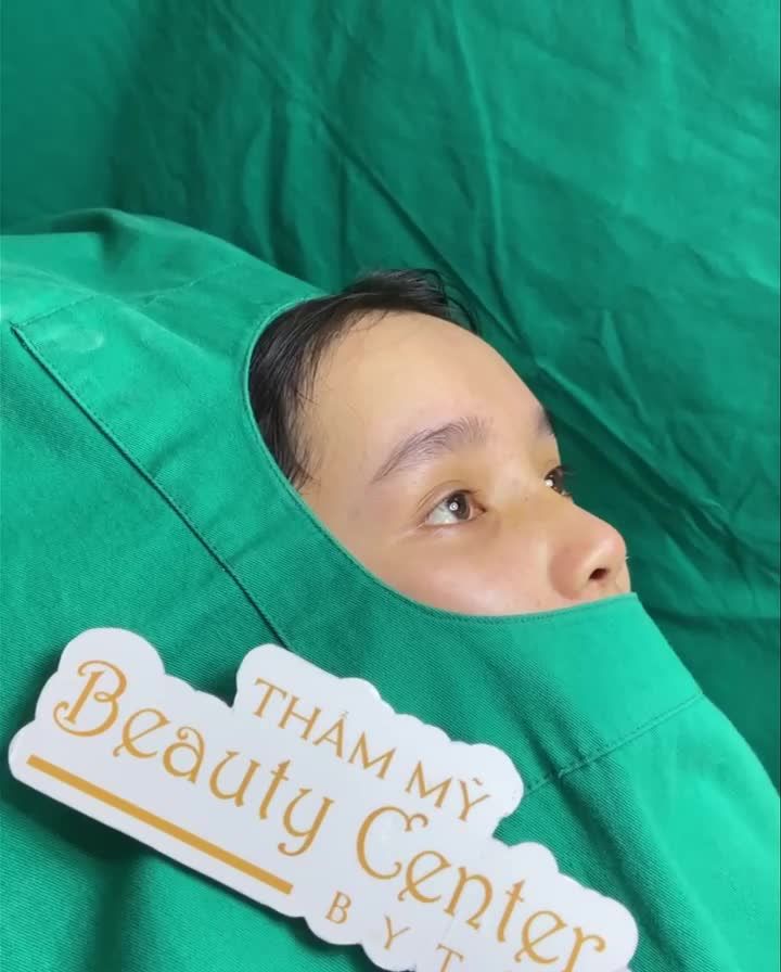 khách cắt chỉ sau 10 ngày sử dụng dịch vụ nâng mũi tại Beauty Center By Tấm.