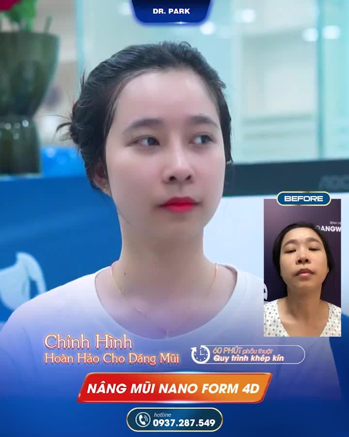 SỰ KHÁC BIỆT CỦA NÂNG MŨI CẤU TRÚC NANOFORM
