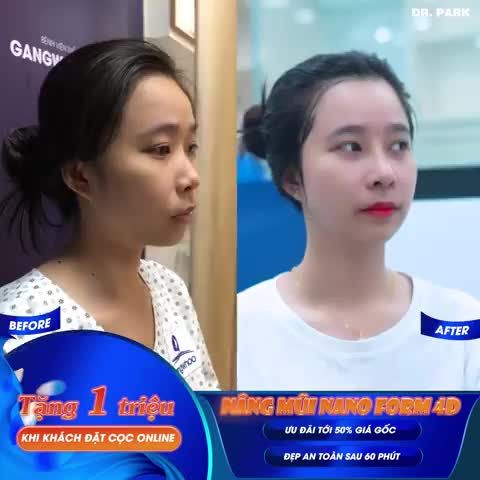 BẠN ĐÃ HIỂU RÕ VỀ KỸ THUẬT NÂNG MŨI CẤU TRÚC