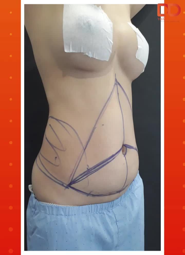 HÚT MỠ VASERlipo TRONG BAO LÂU CÓ CẦN NGHỈ DƯỠNG KHÔNG