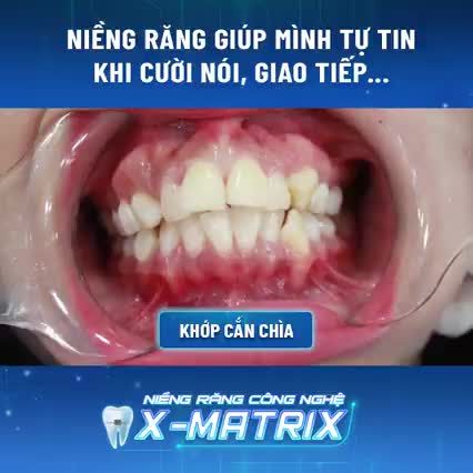 Hết hô, khớp cắn chìa với niềng răng X-Matrix