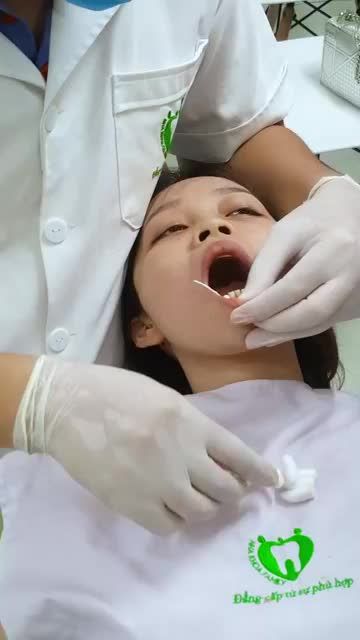 LẮP CỐ ĐỊNH VENEER SỨ CHO KHÁCH HÀNG XINH ĐẸP