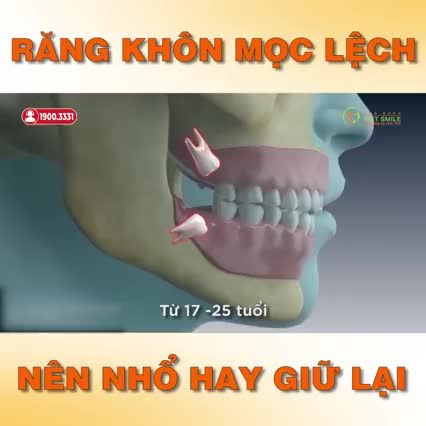 RĂNG KHÔN MỌC LỆCH - N.HỔ BỎ HAY GIỮ LẠI