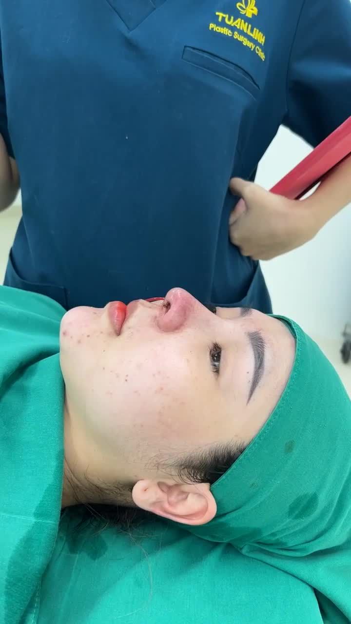 Tiếp tục một cô gái đến từ Đắc Lắk thực hiện nâng mũi siêu cấu trúc tặng sụn Surgiform!