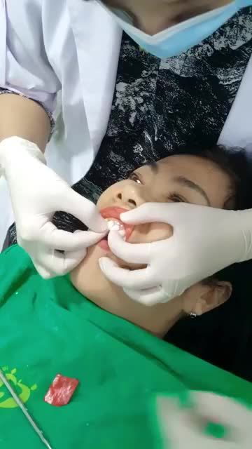 ƯỚM THỬ VENEER SỨ CAO CẤP CHO NỮ KHÁCH HÀNG
