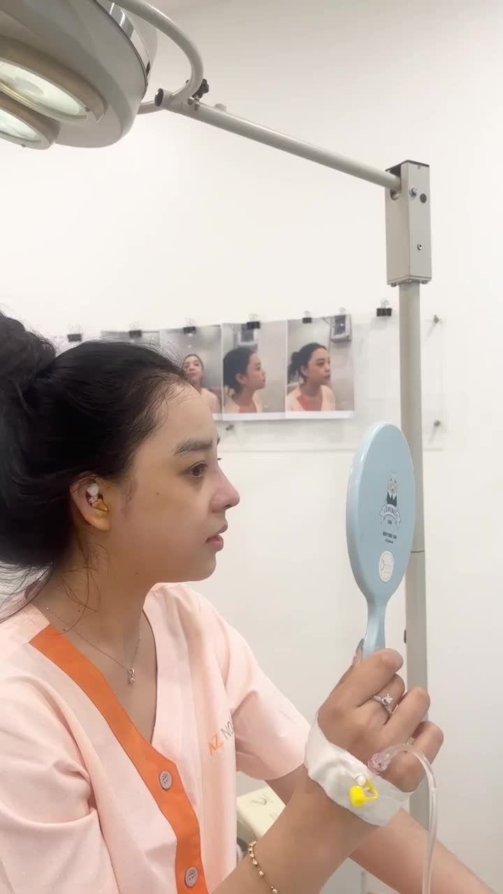 Ca mũi cấu trúc sụn tai surgiform