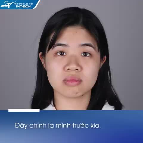 Đỗ Thị Trang Nhung trước khi niềng răng