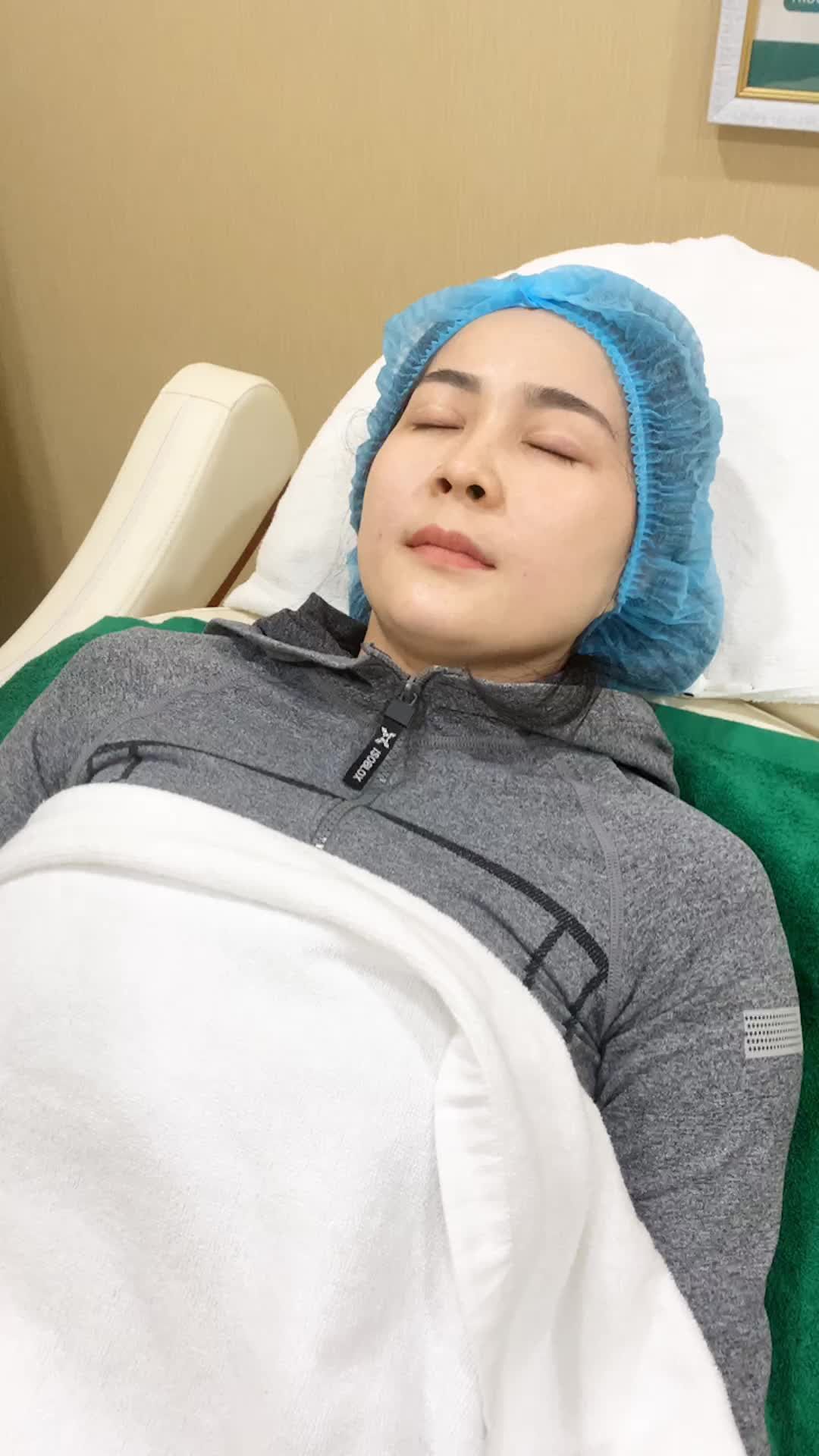 Kết quả TIÊM FILLER RÃNH MÁ, cải thiện tức thì sau 10 phút