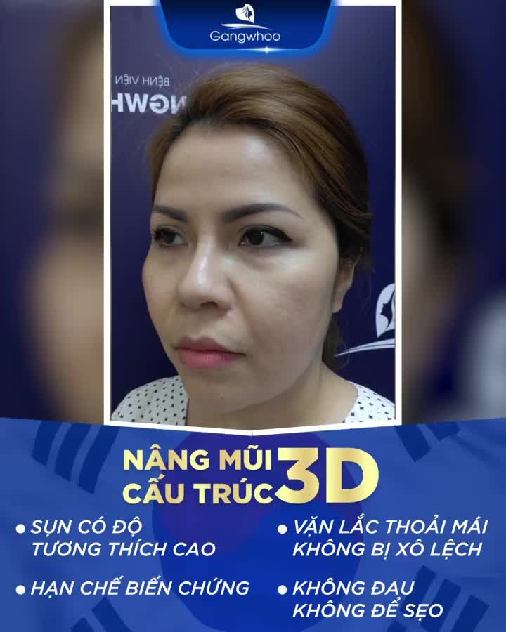 KẾT QUẢ NÂNG MŨI CẤU TRÚC 3D CHO CHỊ KHÁCH HÀNG NGAY TẠI PHÒNG MỔ