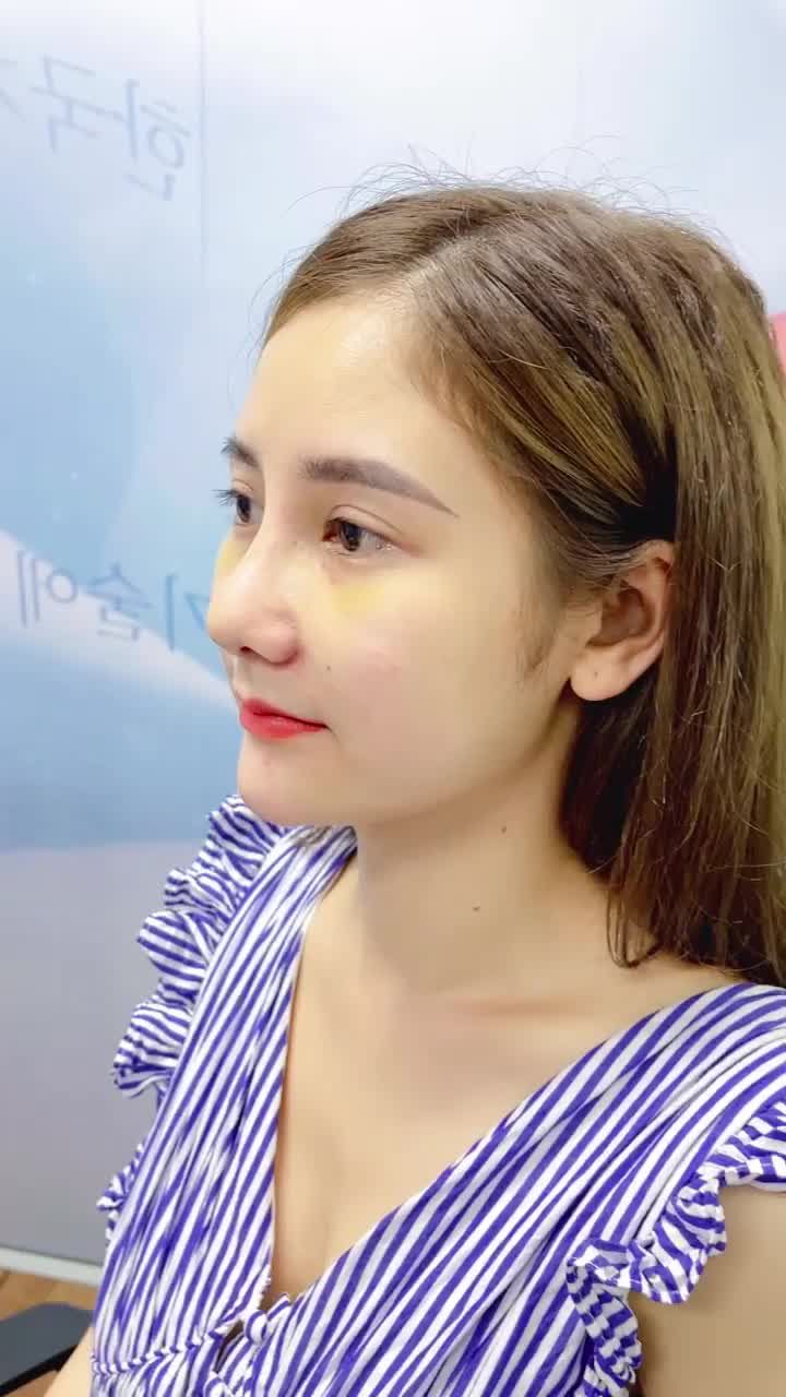 U là trời - Sửa lại mũi thành công và vượt mong đợi!