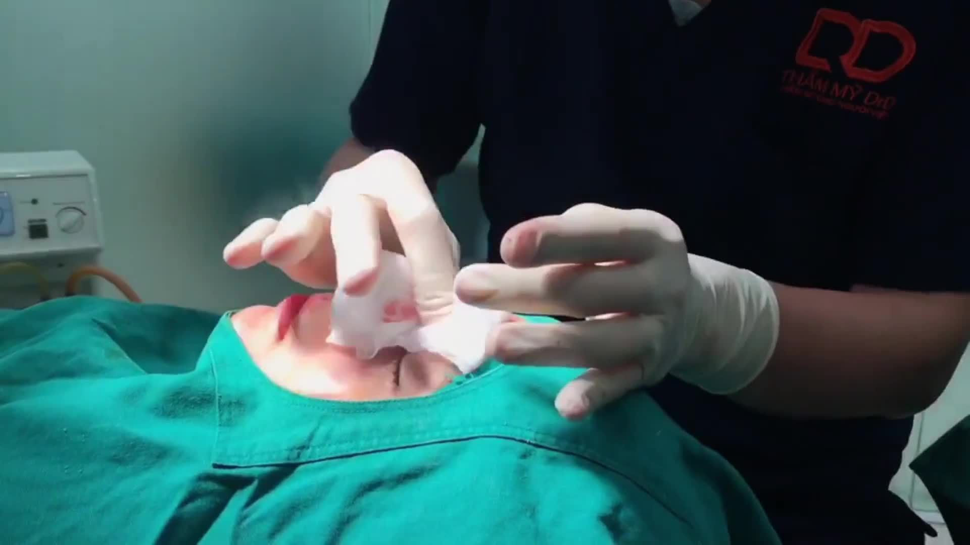 Chị khách hàng đã thực hiện nâng mũi thành công sống mũi cao, thẳng, đầu mũi thon, gọn, dáng mũi mềm mại, tinh tế.