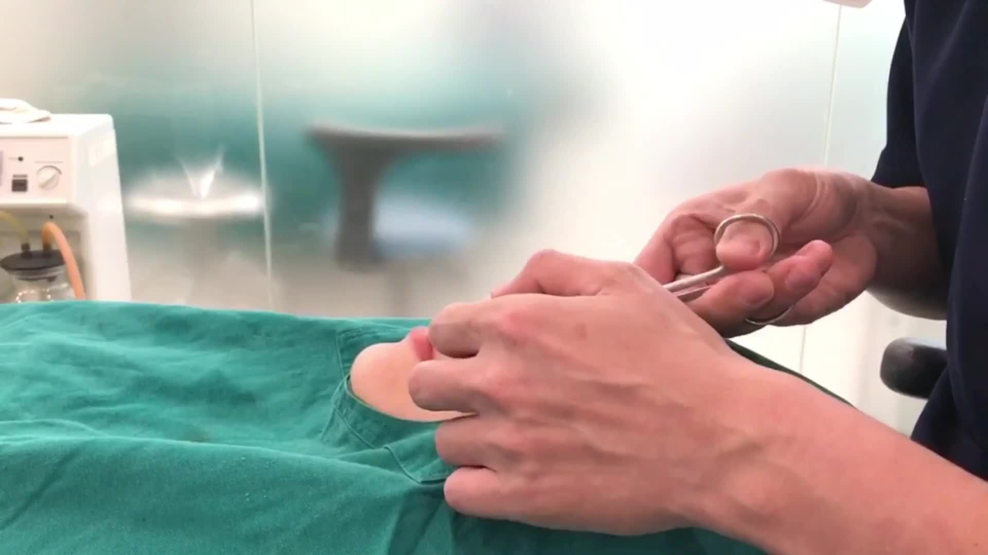 Sau khi kết thúc phẫu thuật nâng mũi bác sĩ sẽ tiến hành nẹp cố định mũi, để hạn chế sưng nề, mũi nhanh về dáng.