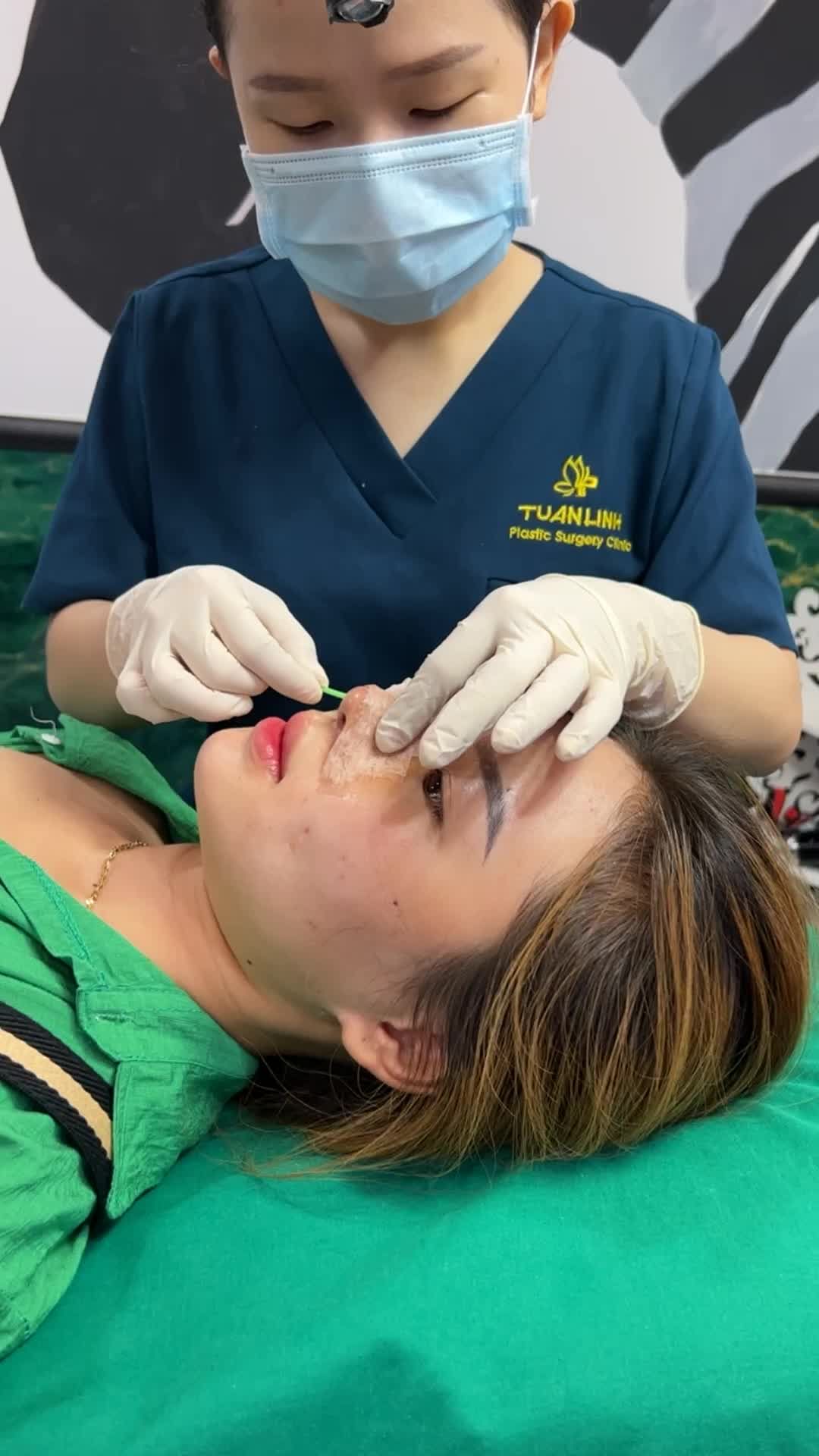 Case Nâng mũi Siêu cấu trúc Surgiform được 5 ngày - khách hàng đến Viện thay nẹp!!