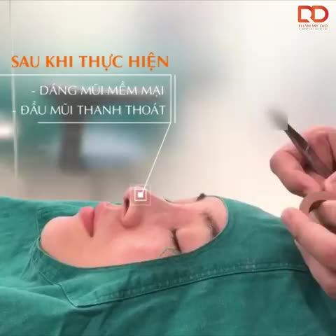 MŨI ĐÃ NÂNG CHỈ, PHẪU THUẬT LẠI CÓ ĐẸP KHÔNG CÂU TRẢ LỜI NẰM Ở PHẦN CLIP CÁC NÀNG NHÉ!
