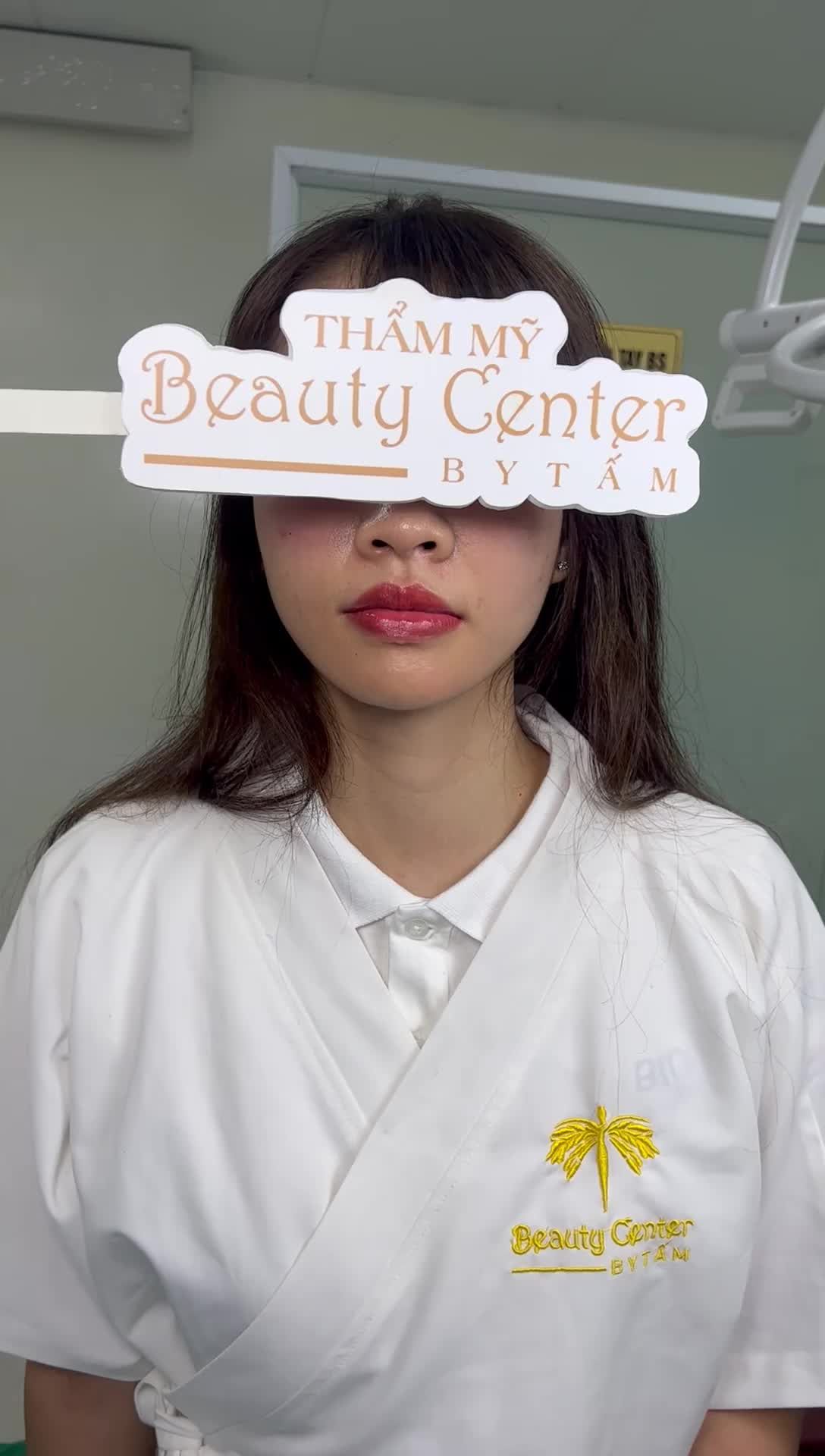 Khuôn mặt tươi trẻ rạng ngời hơn sau khi bạn khách hàng sử dụng dịch vụ Filler má và rãnh cười.
