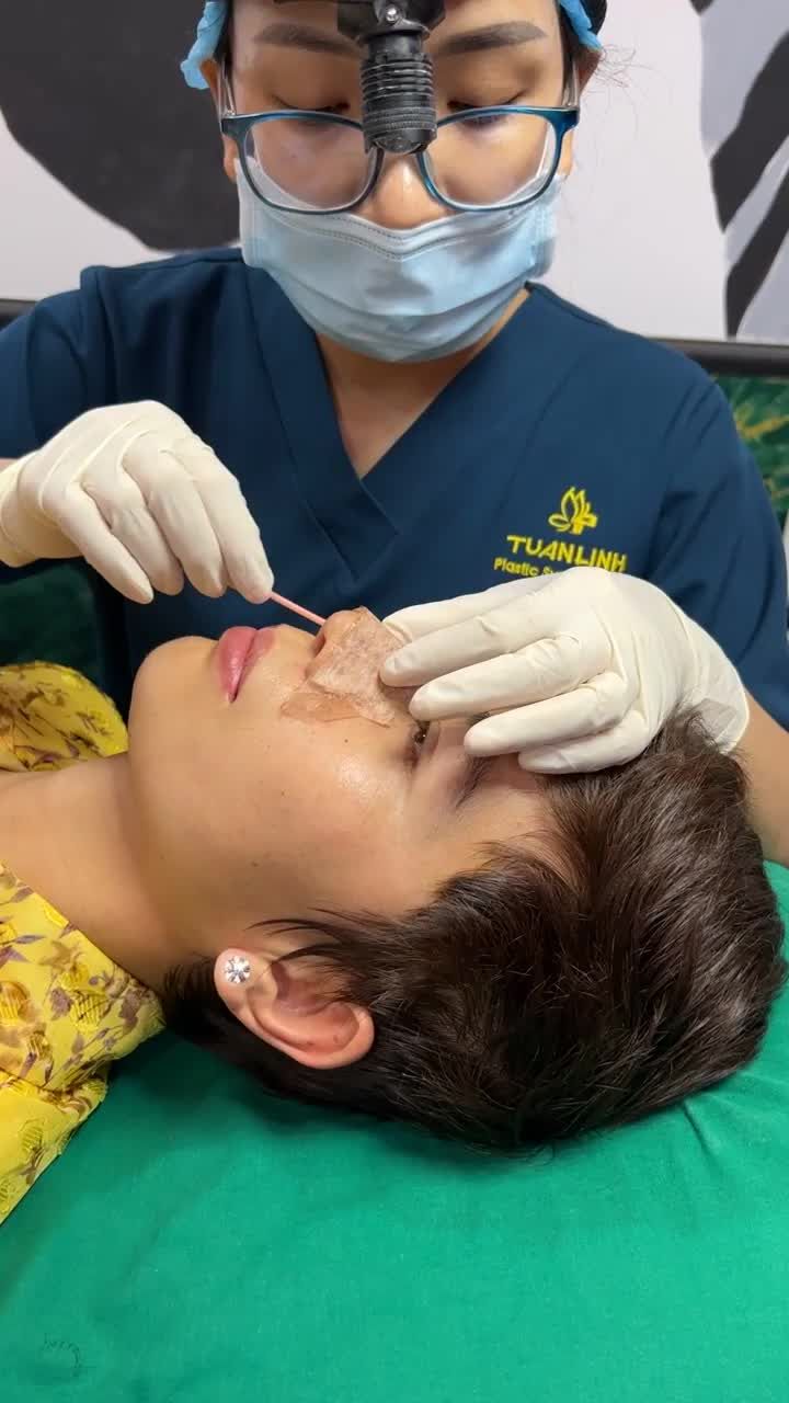 Tiếp tục một ca Tái khám sau 10 ngày Nâng mũi Siêu cấu trúc sụn Surgiform + độn thái dương nhà Tuấn Linh