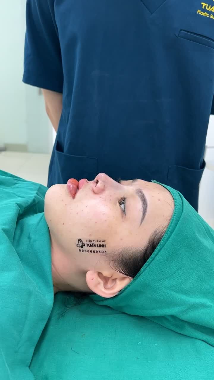 Đầu mũi ngắn, hếch bị co rút sau nâng mũi Hàn Quốc...Khách hàng sửa lại tại Tuấn Linh và Kết quả sau 90 phút phẫu thuật!