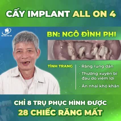 CHỈ 8 TRỤ IMPLANT PHỤC HÌNH ĐƯỢC 28 RĂNG ĐÃ MẤT