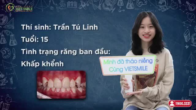 NỤ CƯỜI MỚI TỰ TIN SAU THÁO NIỀNG RĂNG KHẤP KHỂNH