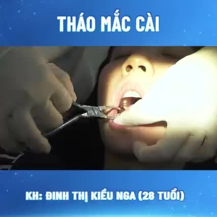 THÁO MẮC CÀI - TẠM BIỆT RĂNG HÔ