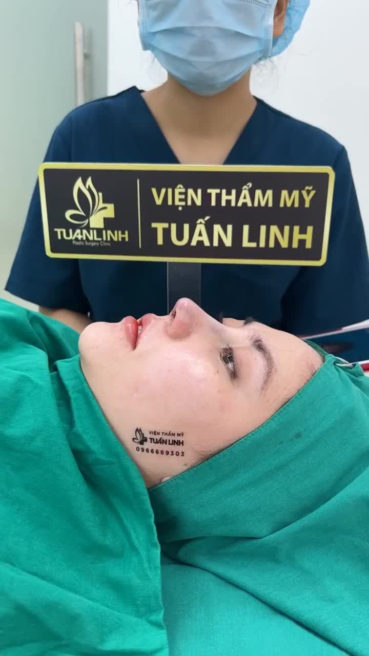 Nâng mũi Siêu cấu trúc tặng sụn surgiform.