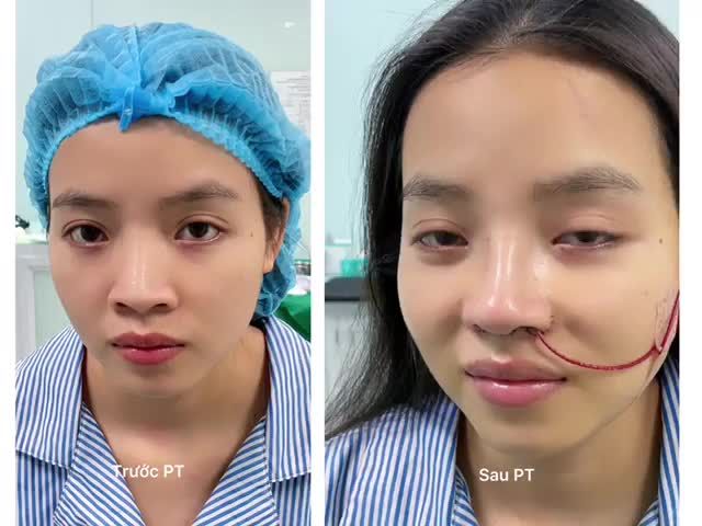 Sở hữu dáng mũi đẹp tự nhiên không còn khó vì đã có Latin