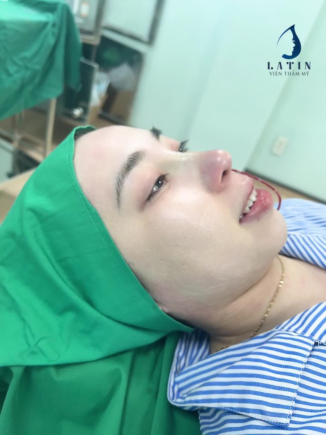 Hành trình thay đổi dáng mũi của chị khách dễ thương
