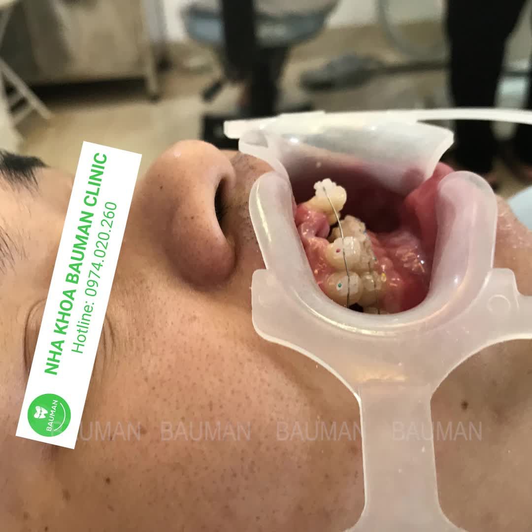 CA NIỀNG RĂNG 5220| Nha Khoa Bauman