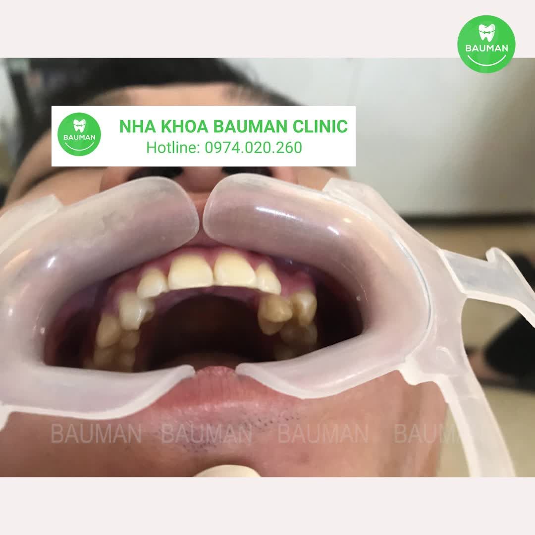 Ca niềng răng 5221| Nha Khoa Bauman