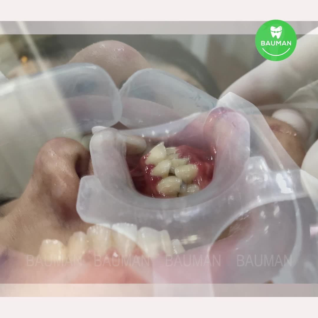 Ca niềng răng 5222| Nha Khoa Bauman