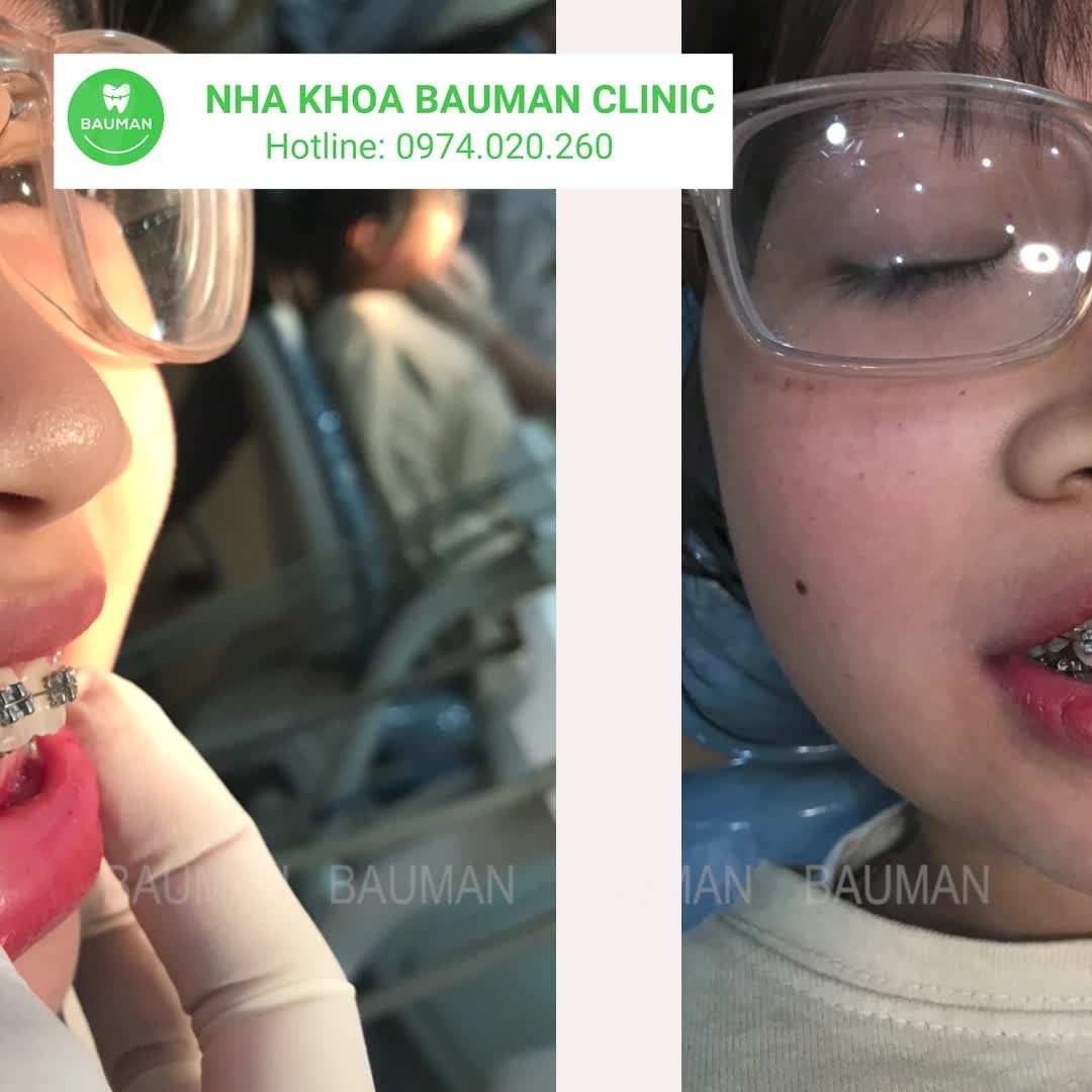 Ca niềng răng 5224| Nha Khoa Bauman