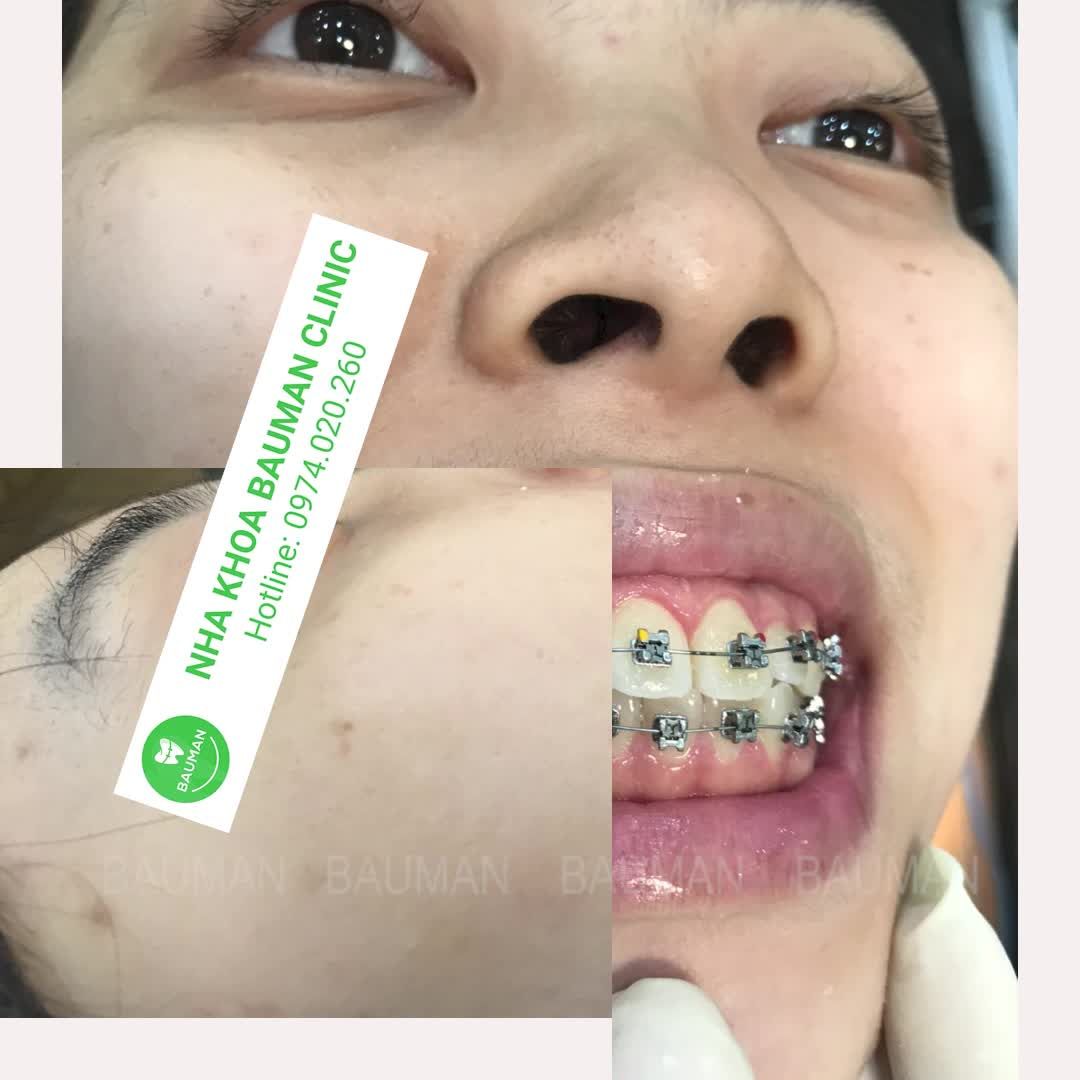Ca niềng răng 5226| Nha Khoa Bauman