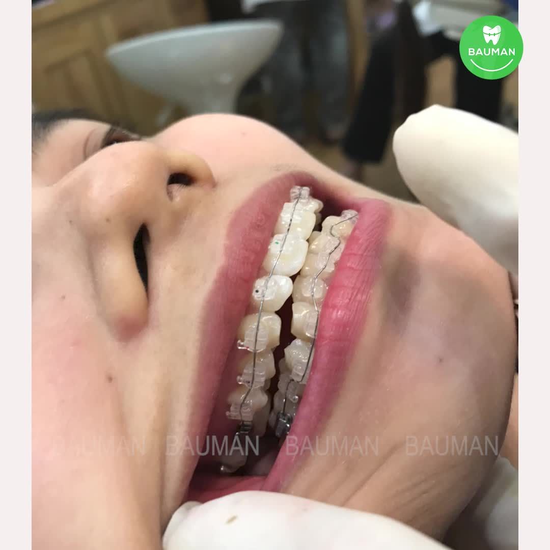 Ca niềng răng 5227| Nha Khoa Bauman