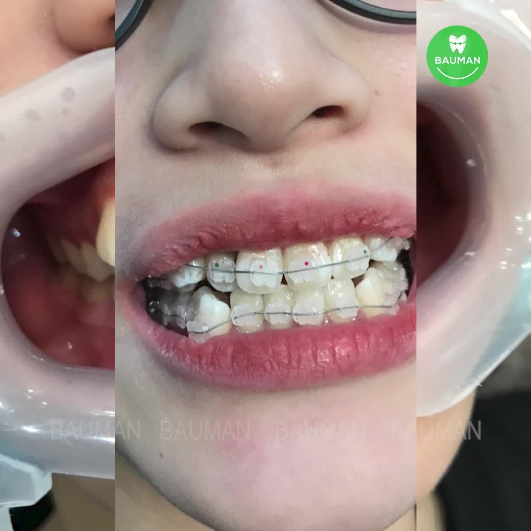Ca niềng răng 5229| Nha Khoa Bauman