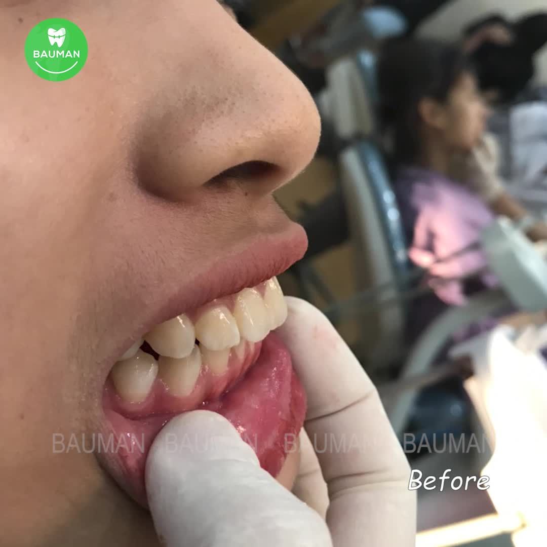 Ca niềng răng 5231| Nha Khoa Bauman