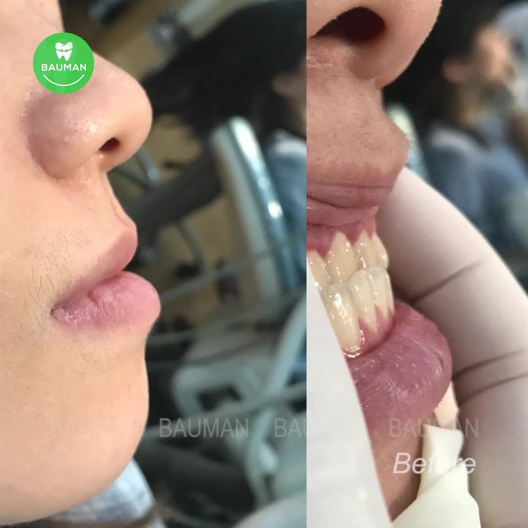 Ca niềng răng 5232| Nha Khoa Bauman