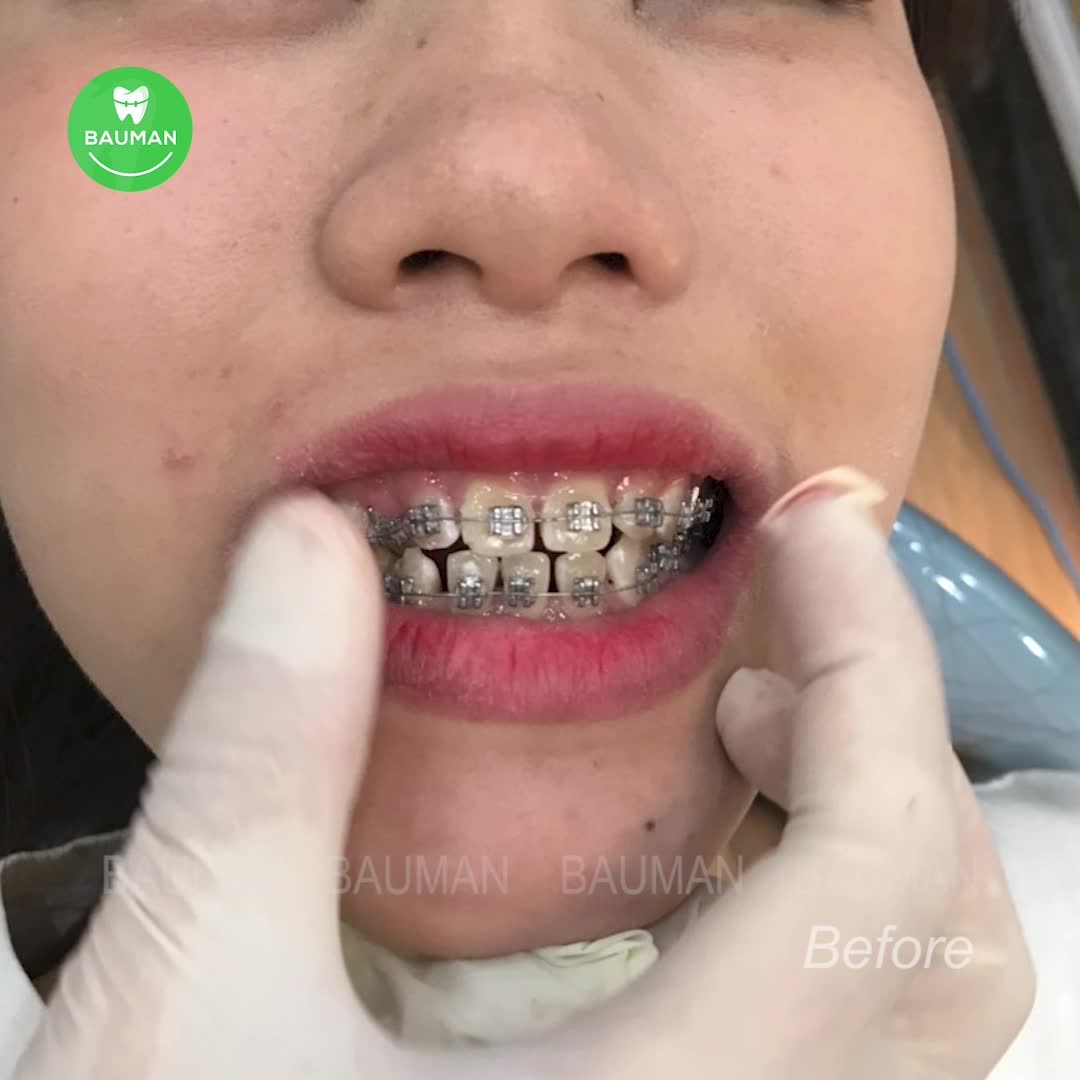 Ca niềng răng 5233| Nha Khoa Bauman
