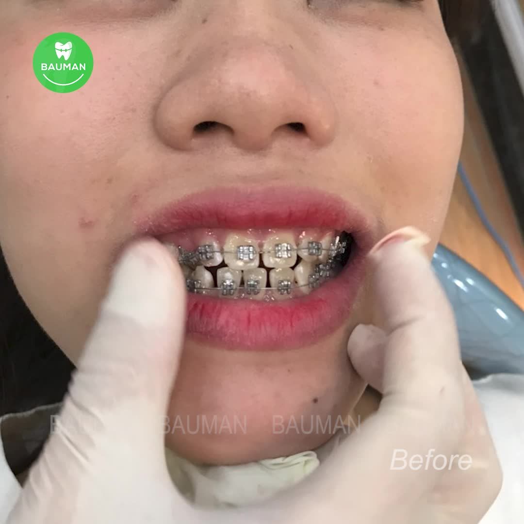 Ca niềng răng 5233| Nha Khoa Bauman