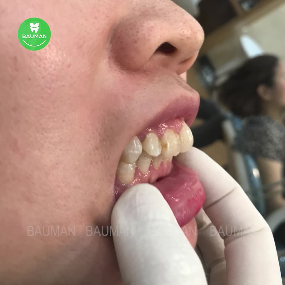 Ca niềng răng 5234| Nha Khoa Bauman