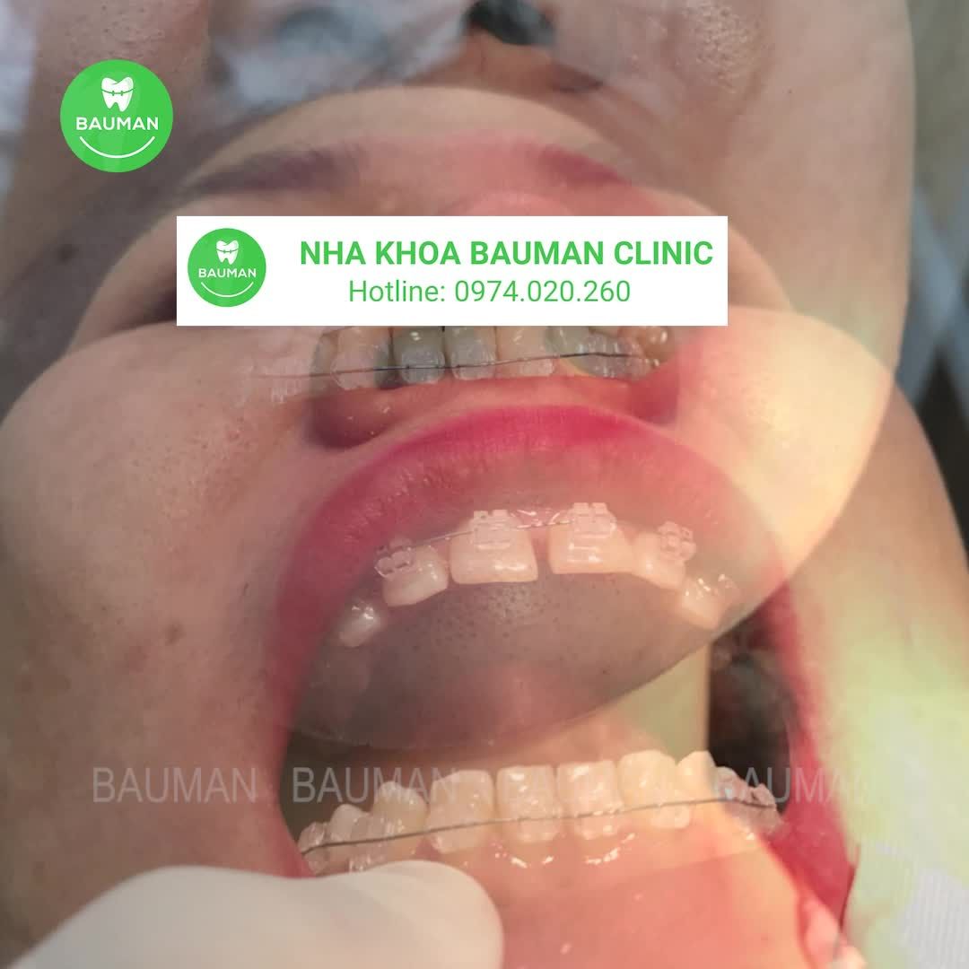 Ca niềng răng 5235| Nha Khoa Bauman
