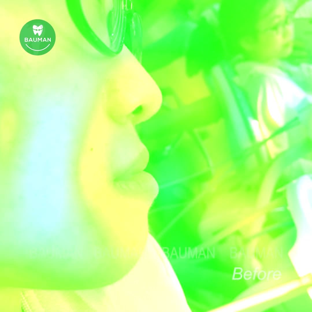 Ca niềng răng 5236| Nha Khoa Bauman