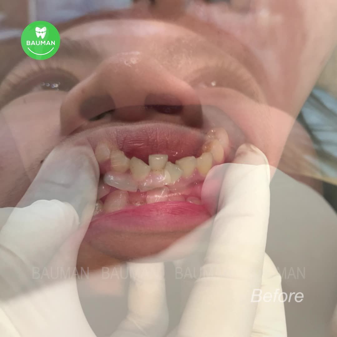 Ca niềng răng 5237| Nha Khoa Bauman