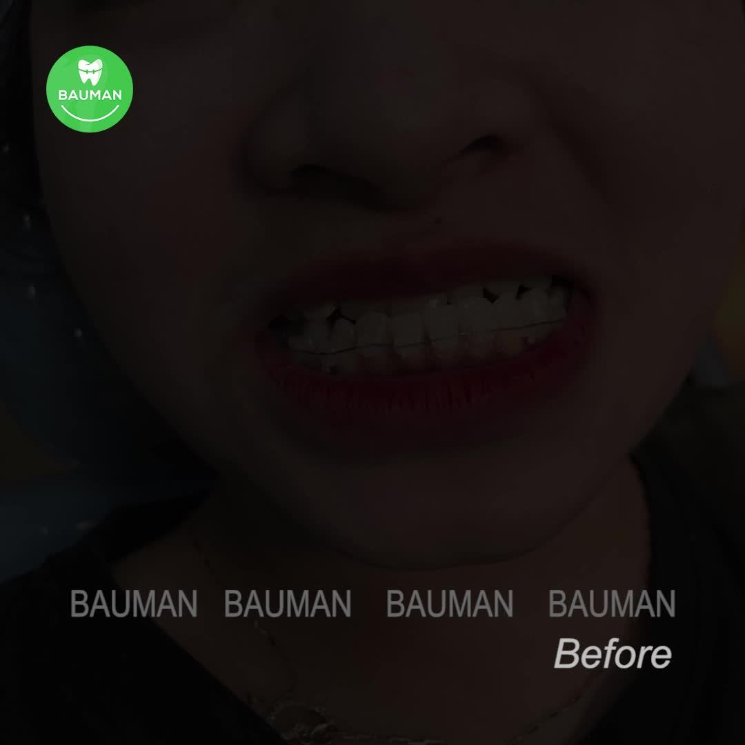 Ca niềng răng 5238| Nha Khoa Bauman